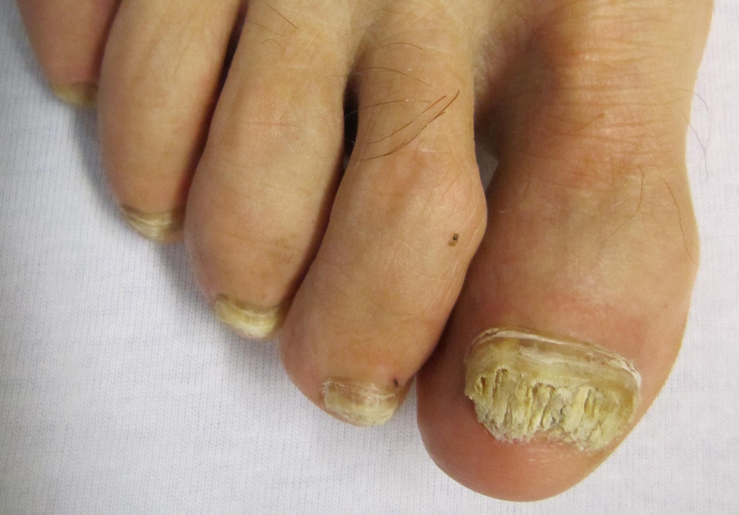 Fungal Toenails