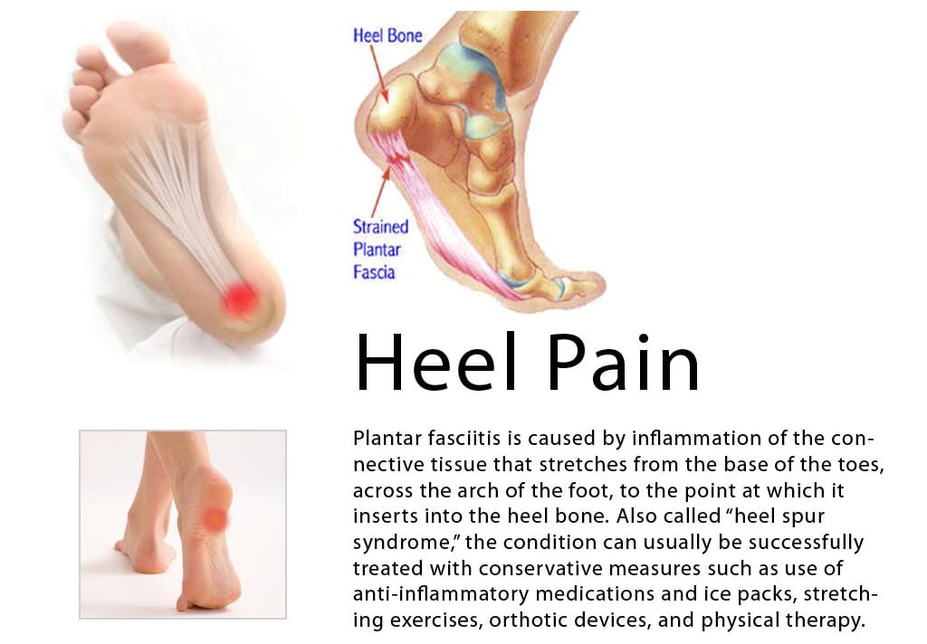 Heel Pain