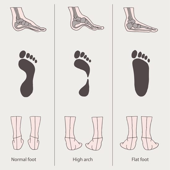 Flat Foot