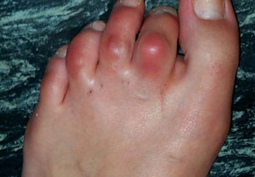 Hammer toe