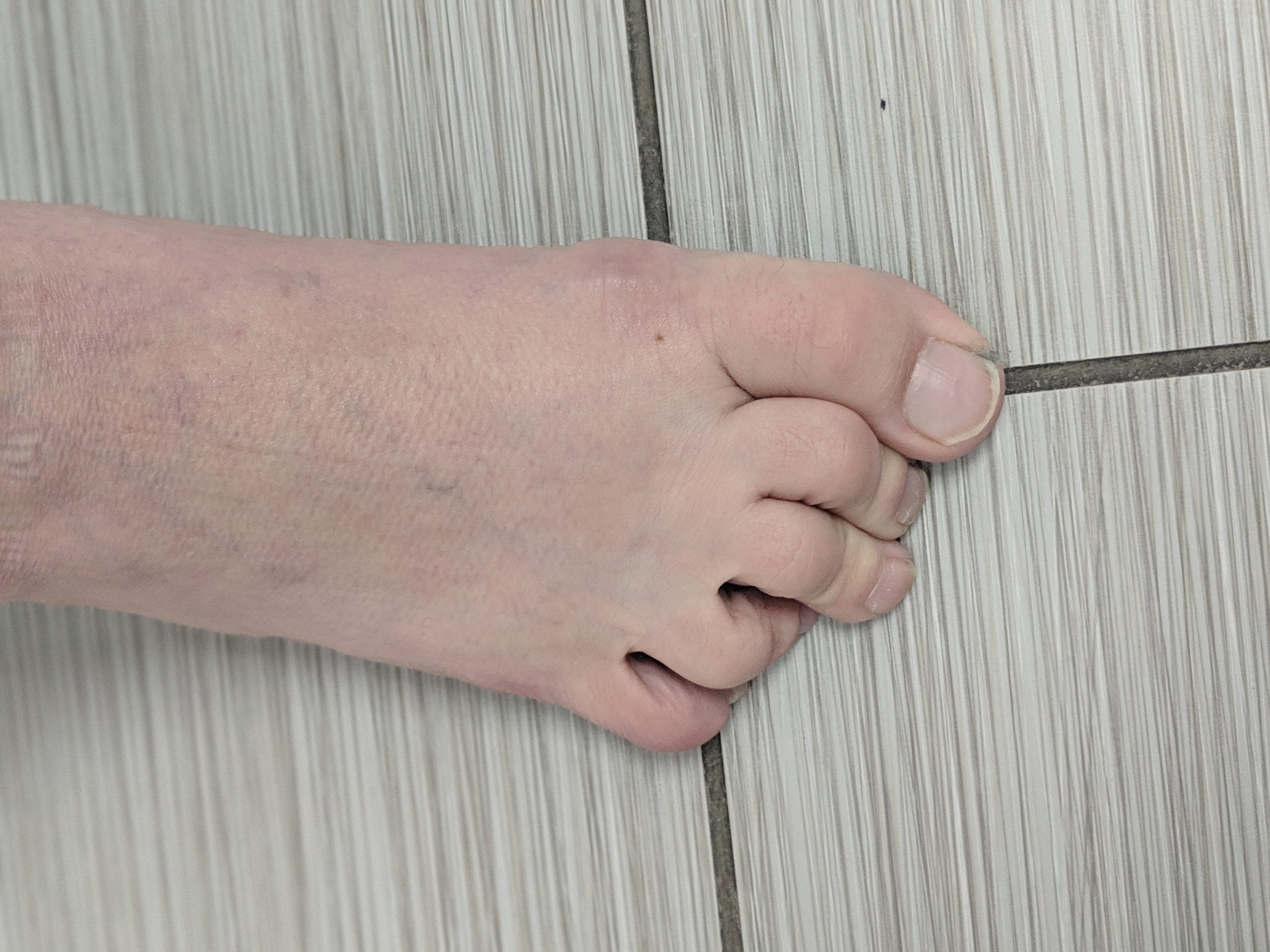 What are Hammer toes - Bruyere Foot Specialists