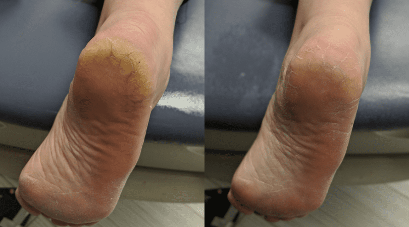 Amazon shoppers swear by this $8 foot cream that can heal dry, cracked feet  fast: 'Within 2-3 uses I saw a huge improvement'