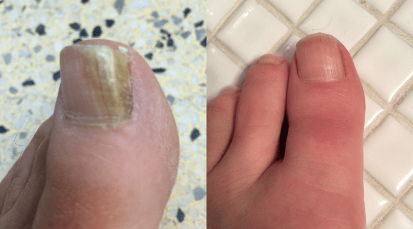 Before and after fungal nail